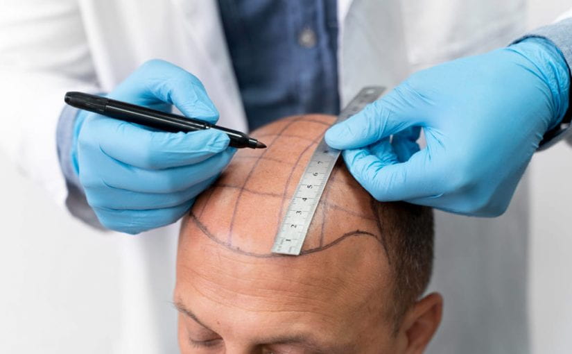 Can a Fully Bald Person Get a Hair Transplant?