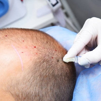 Do and Don’ts after Hair Transplant?